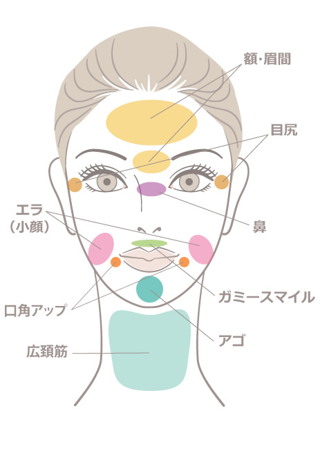 ボトックス注入箇所
